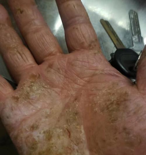 黄脓疮（探索黄脓疮的成因、症状以及有效治疗方法）