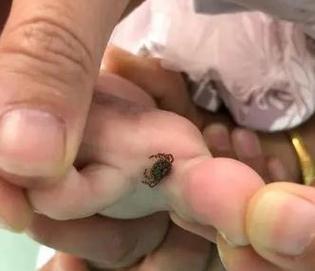 被蜱虫咬的症状及应对方法（了解蜱虫咬伤后的症状以及采取适当的预防措施，保护自己的健康。）