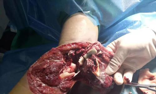 狗肘关节囊肿消退的时间与方法（探索狗肘关节囊肿的症状、治疗和康复关键）