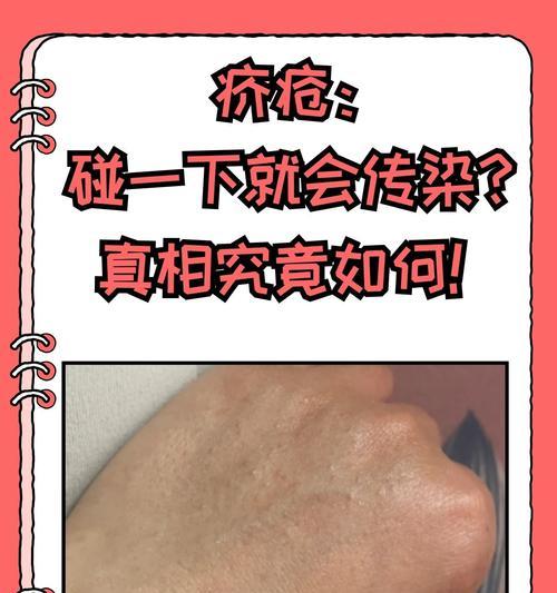 皮肤病传染性研究（探索皮肤病传染性的关键因素与预防方法）