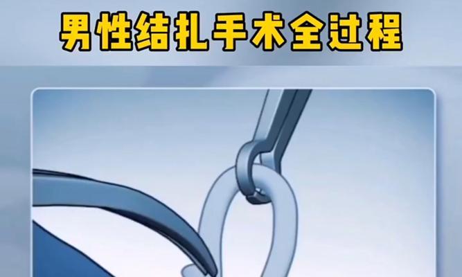 结扎的缺点与风险（为什么结扎不是完美的选择）